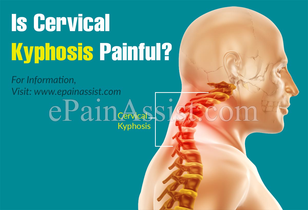 Is Cervical Kyphosis Painful