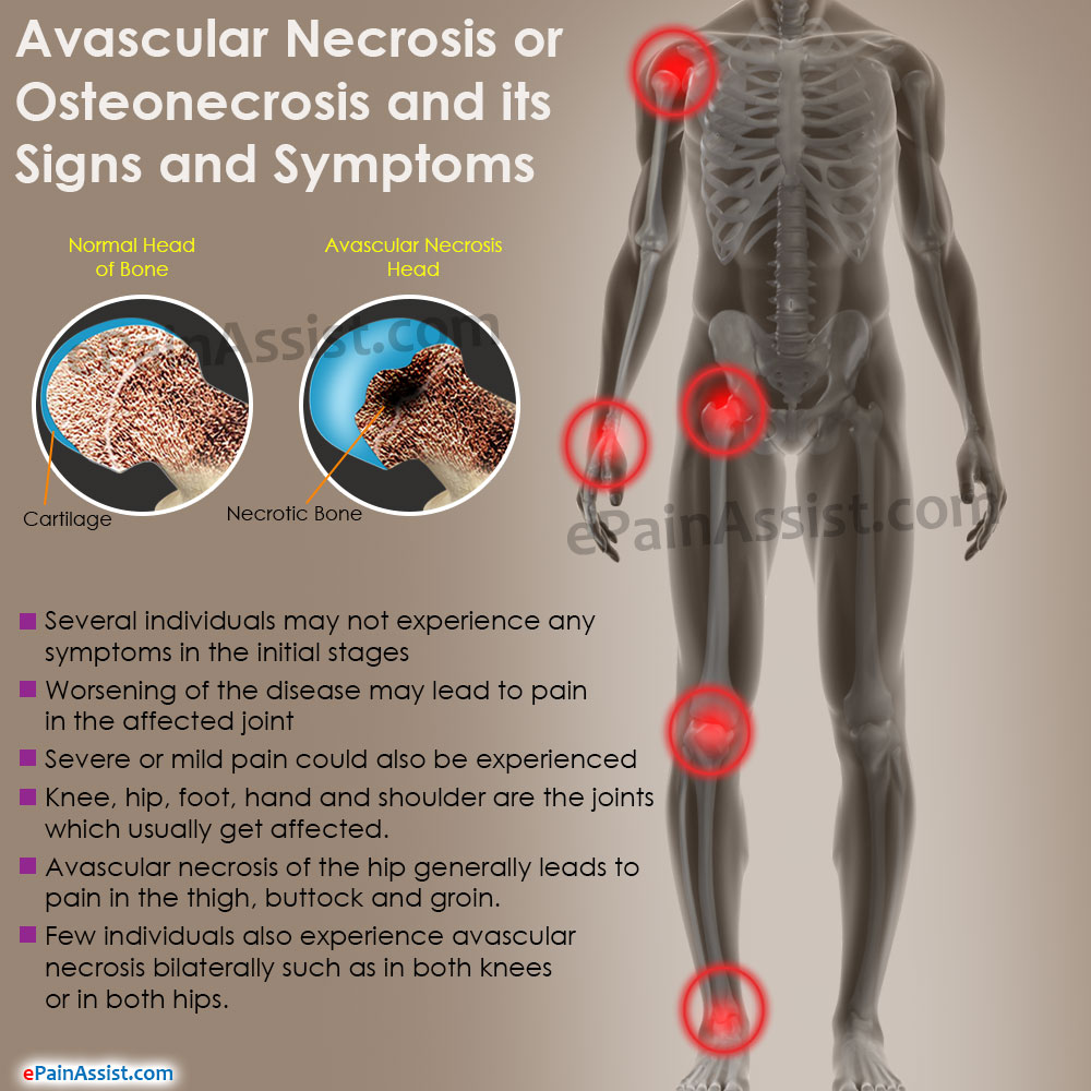Avascular Necrosis Or Osteonecrosis Treatment Causes Symptoms Types