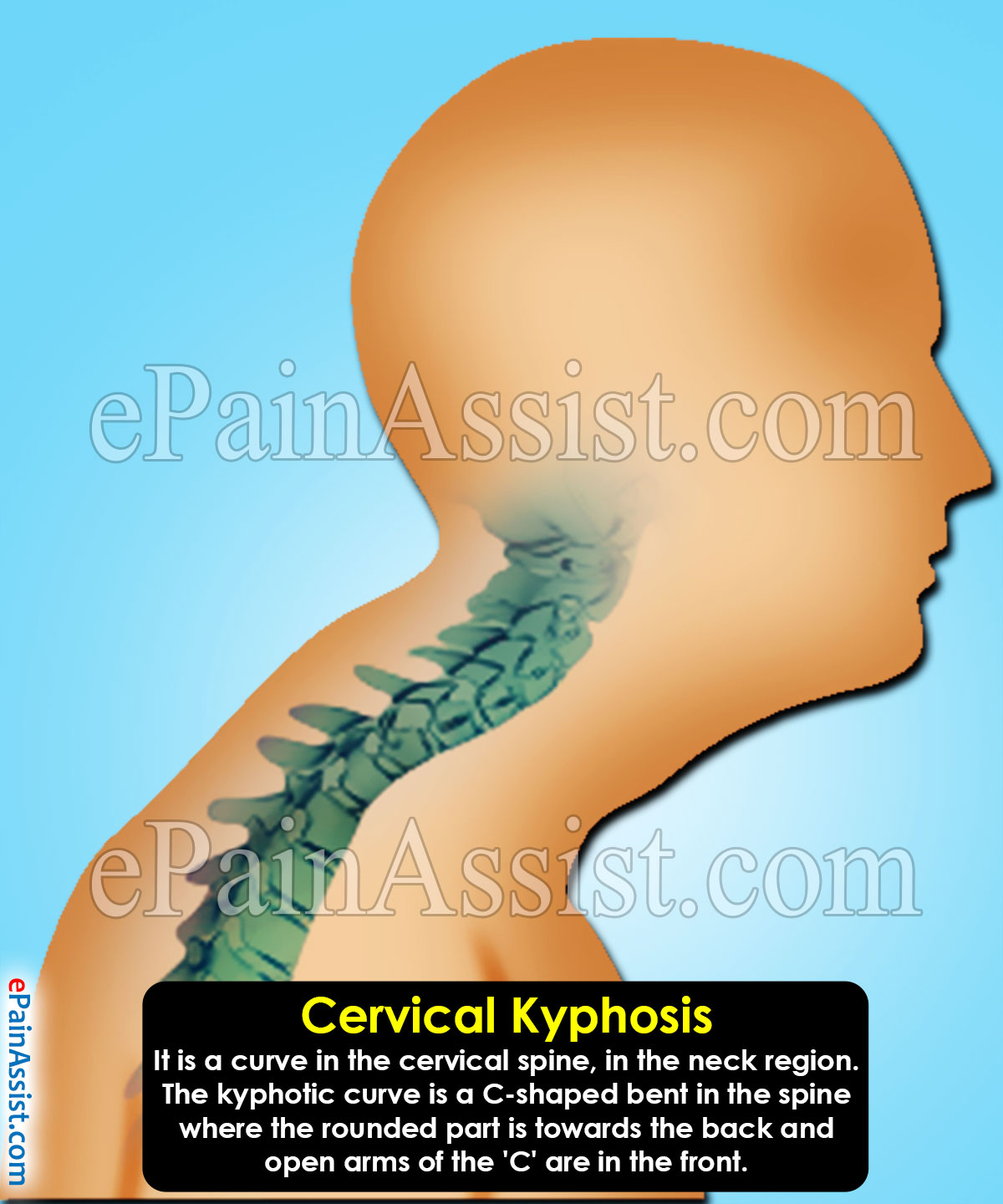 Cervical Kyphosis Causes Symptoms Treatment Exercise