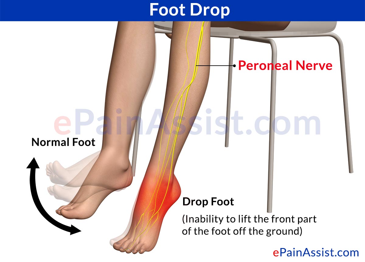 Foot Drop (AKA “Drop Foot” or “Peroneal Nerve Injury