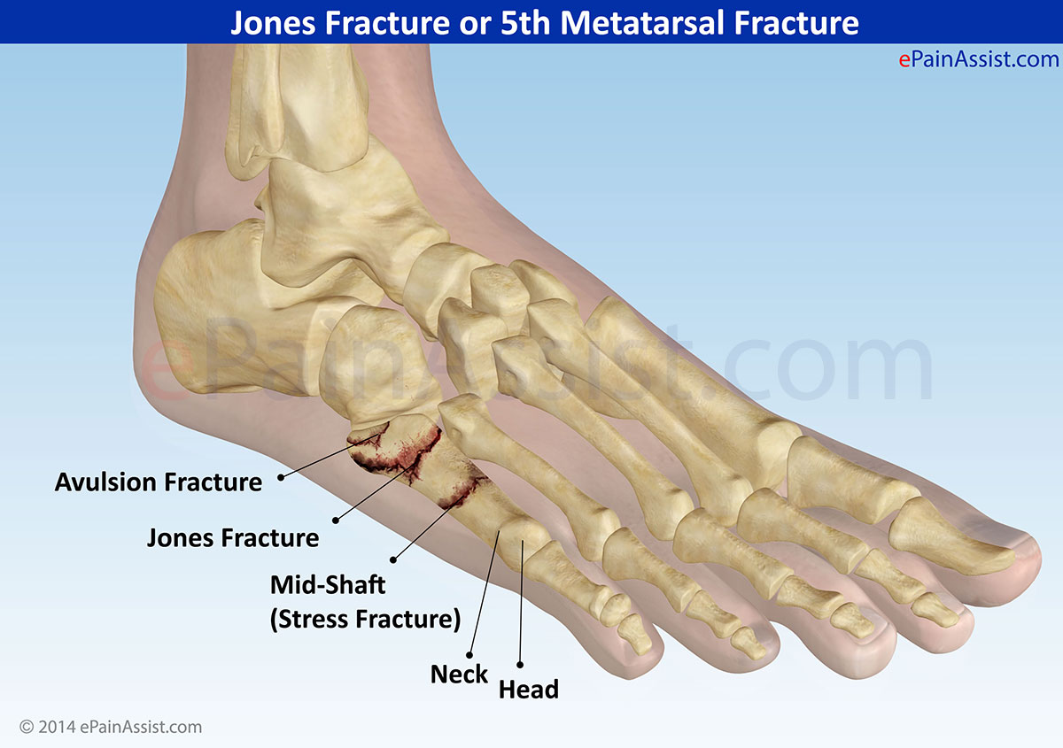 Jones Fracture Or 5th Metatarsal Fracturecausessymptomstreatment Cast Rehab