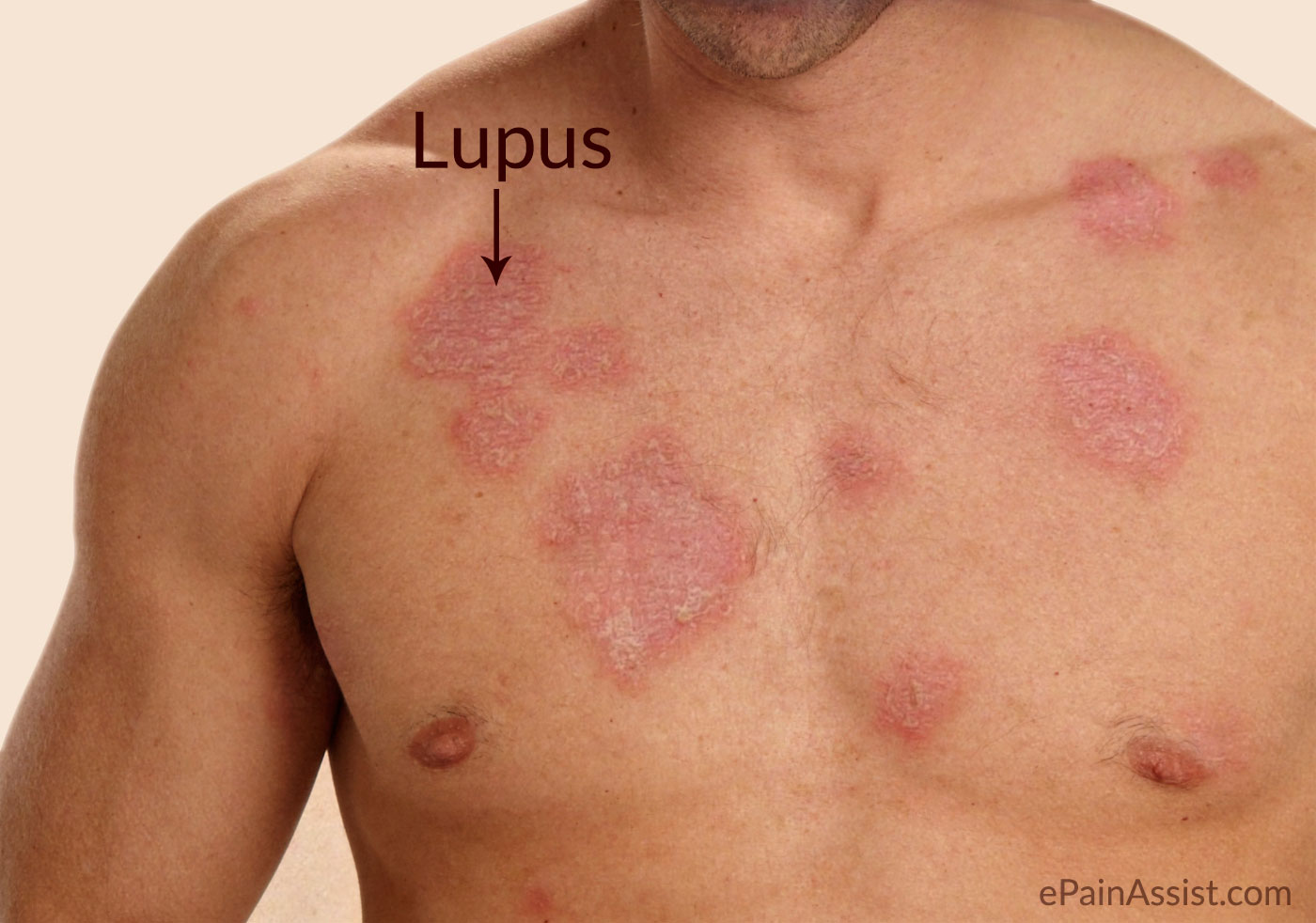 what is lupus