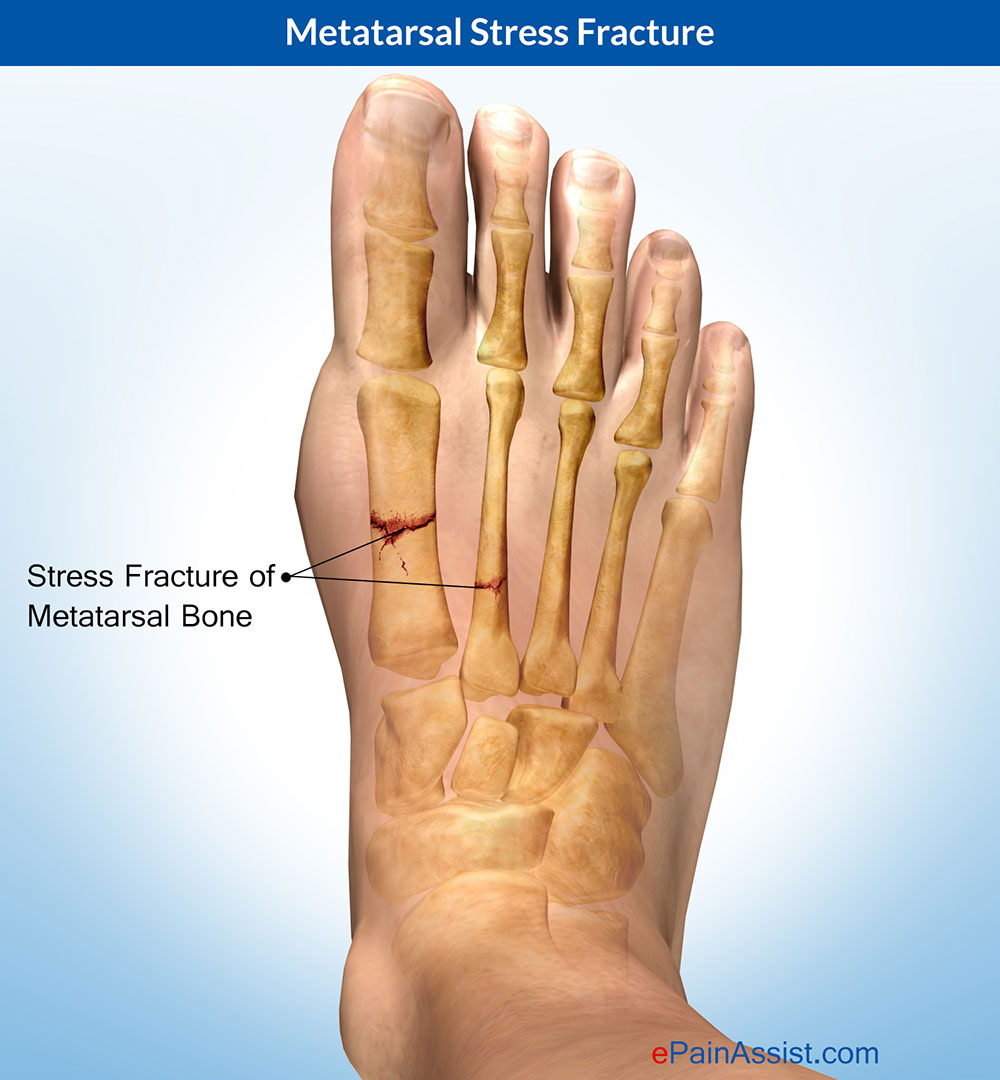 Metatarsal Stress Fracture Treatment Symptoms Recovery Causes