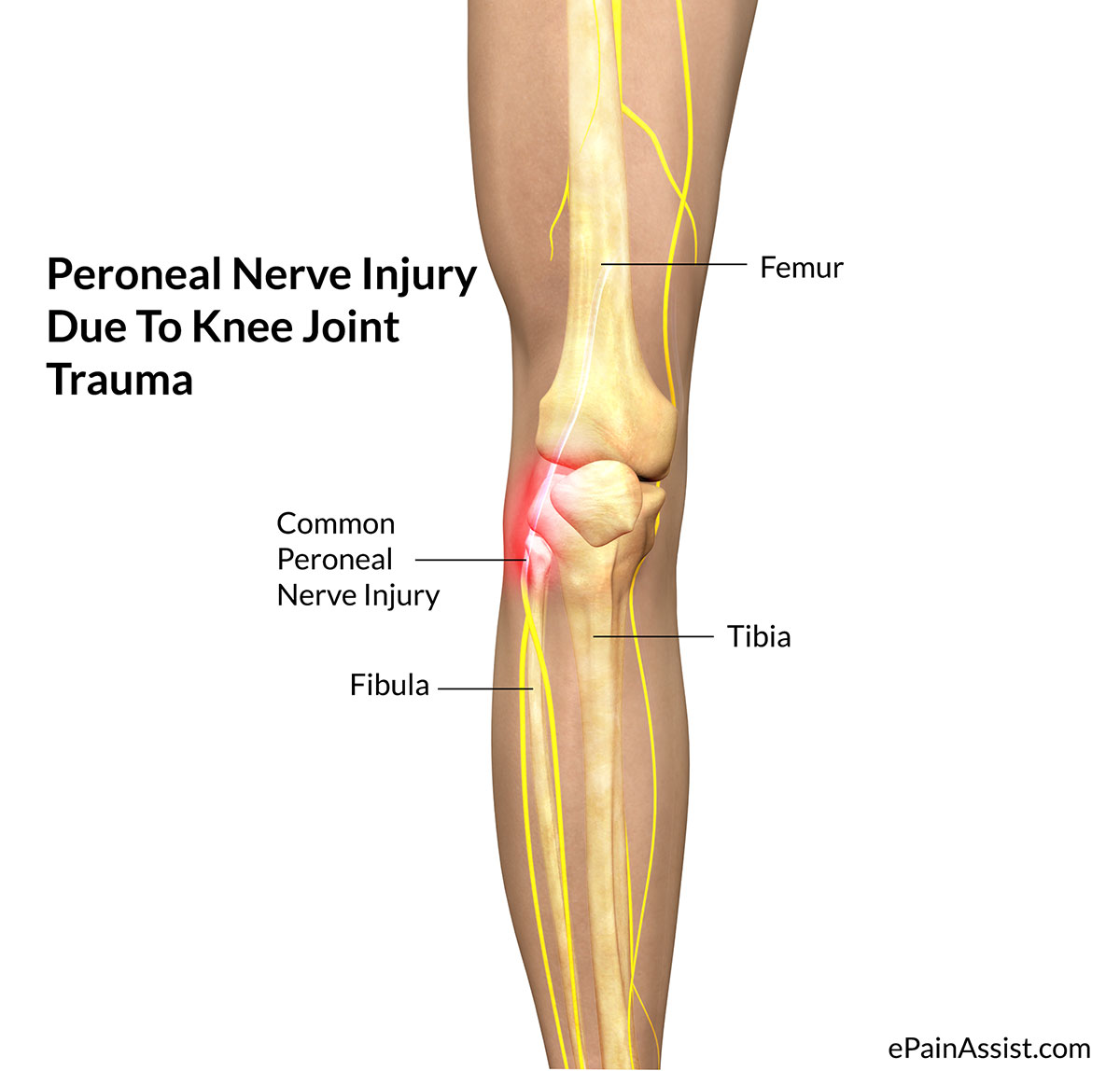 Peroneal-Nerve-Injury.jpg