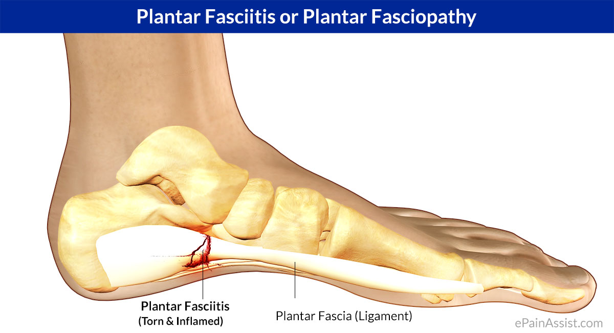 What Is Plantar Fasciitis