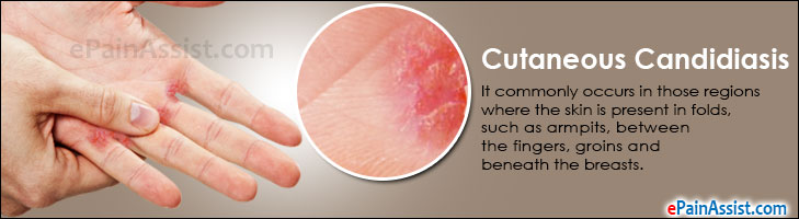 Signs And Symptoms Of Candidiasis In Males Thrush Symptoms Causes