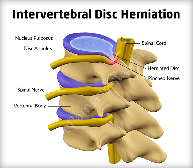 intervertebral disc herniation: types, symptoms, treatment