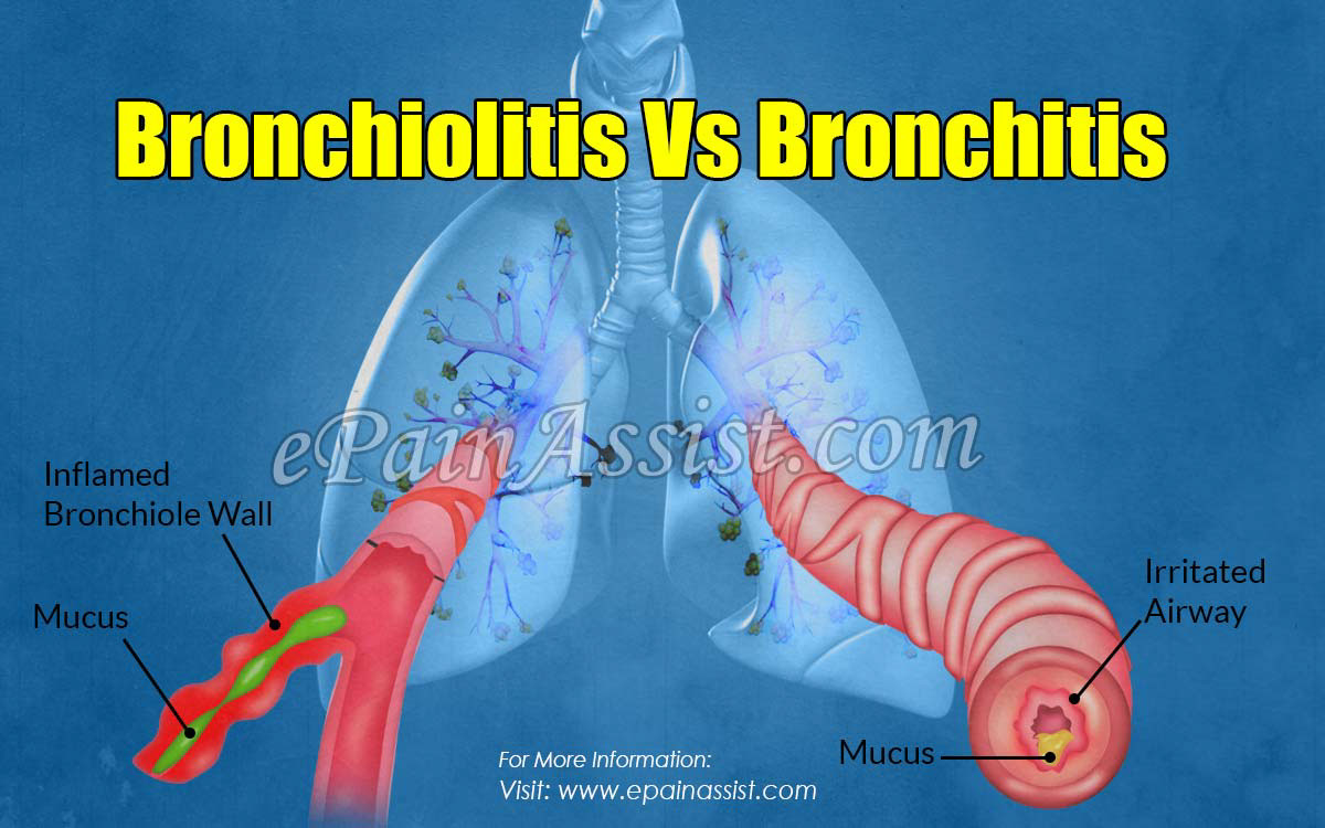 Bronchiolitis Vs Bronchitis Differences Based On Causes Symptoms