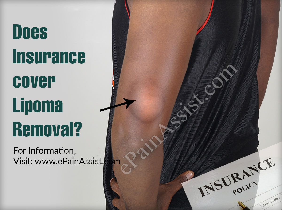 Does Insurance Cover Lipoma Removal?