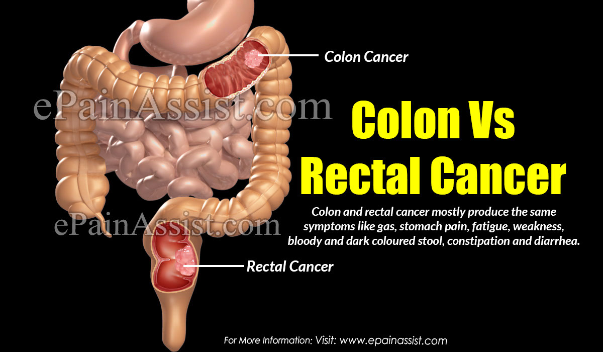 Difference Between Colon And Rectal Cancer Based On Origin Of Cancer