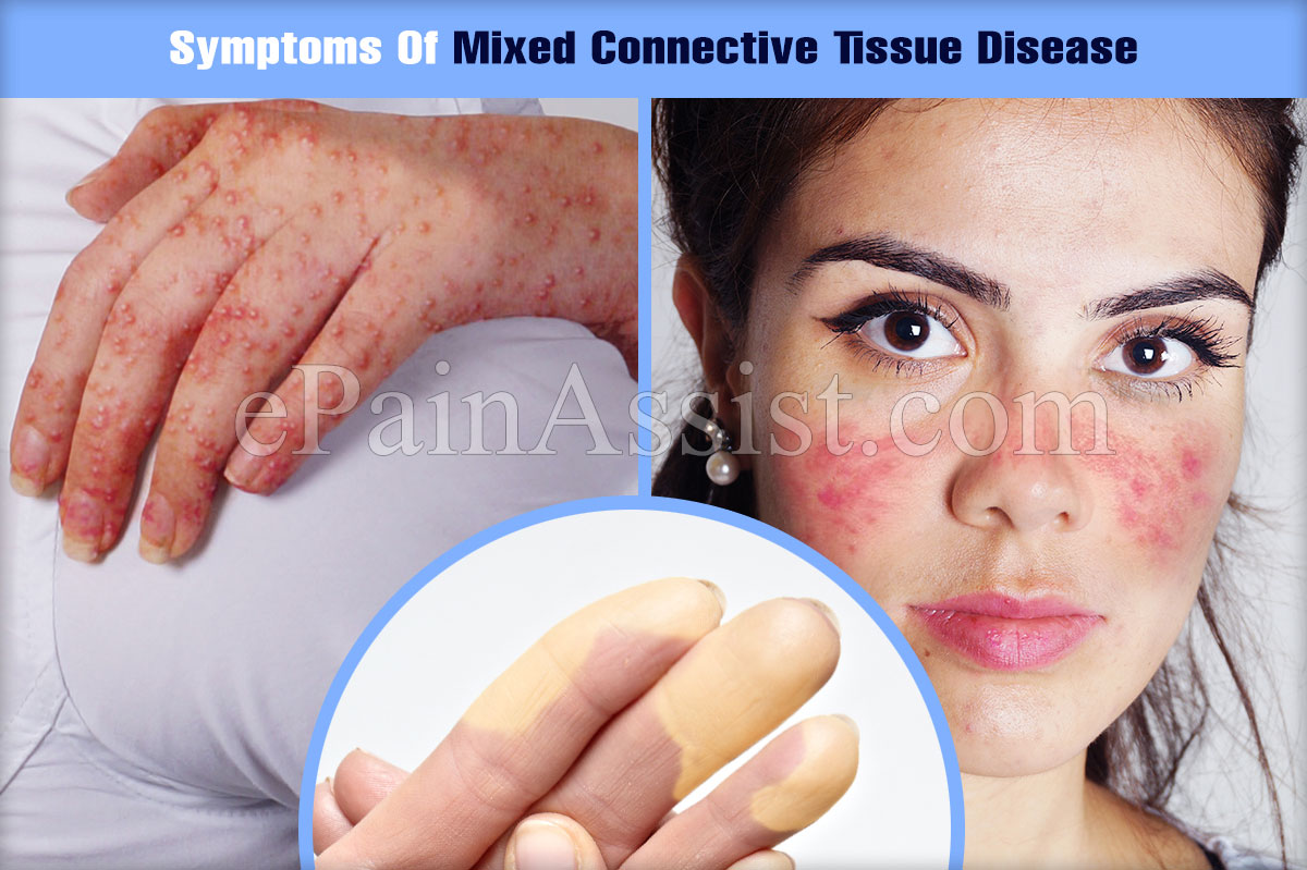 Lupus Connective Tissue Disease Symptoms