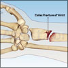 colles fracture broken wrist