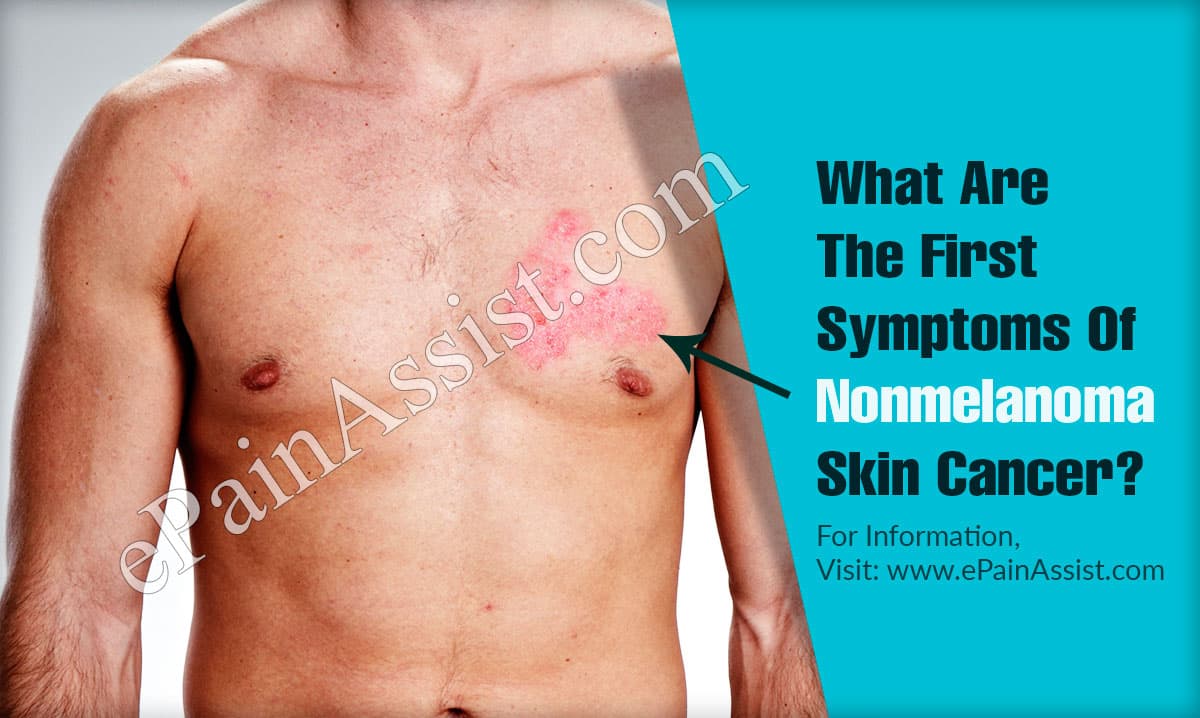 What Are The First Symptoms Of Nonmelanoma Skin Cancer & How Do You ...