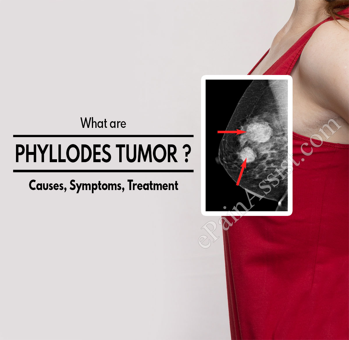 thesis on phyllodes tumor