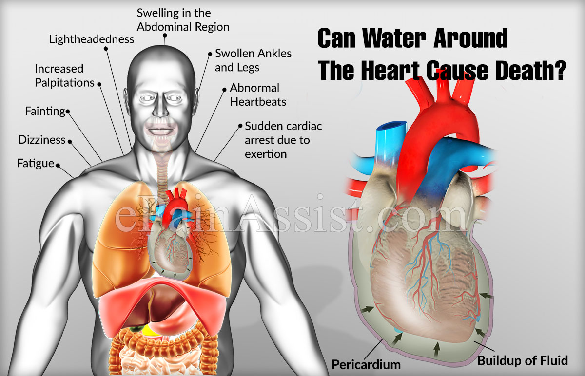 symptoms of fluid around the heart