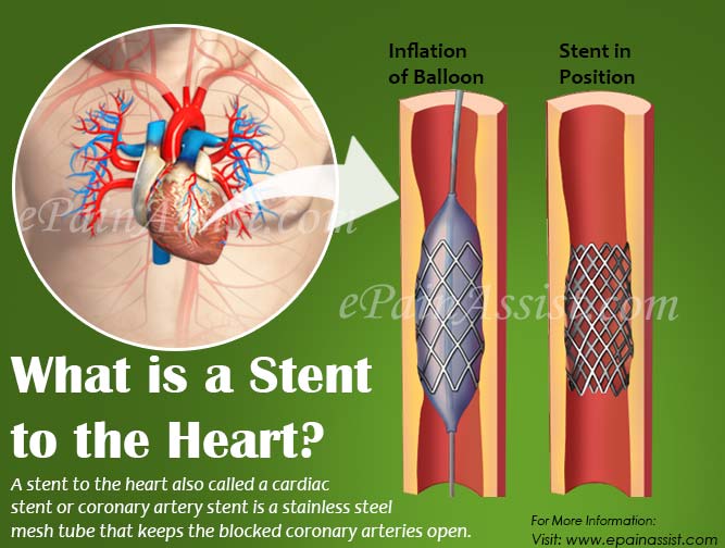 What is a Stent to the Heart?