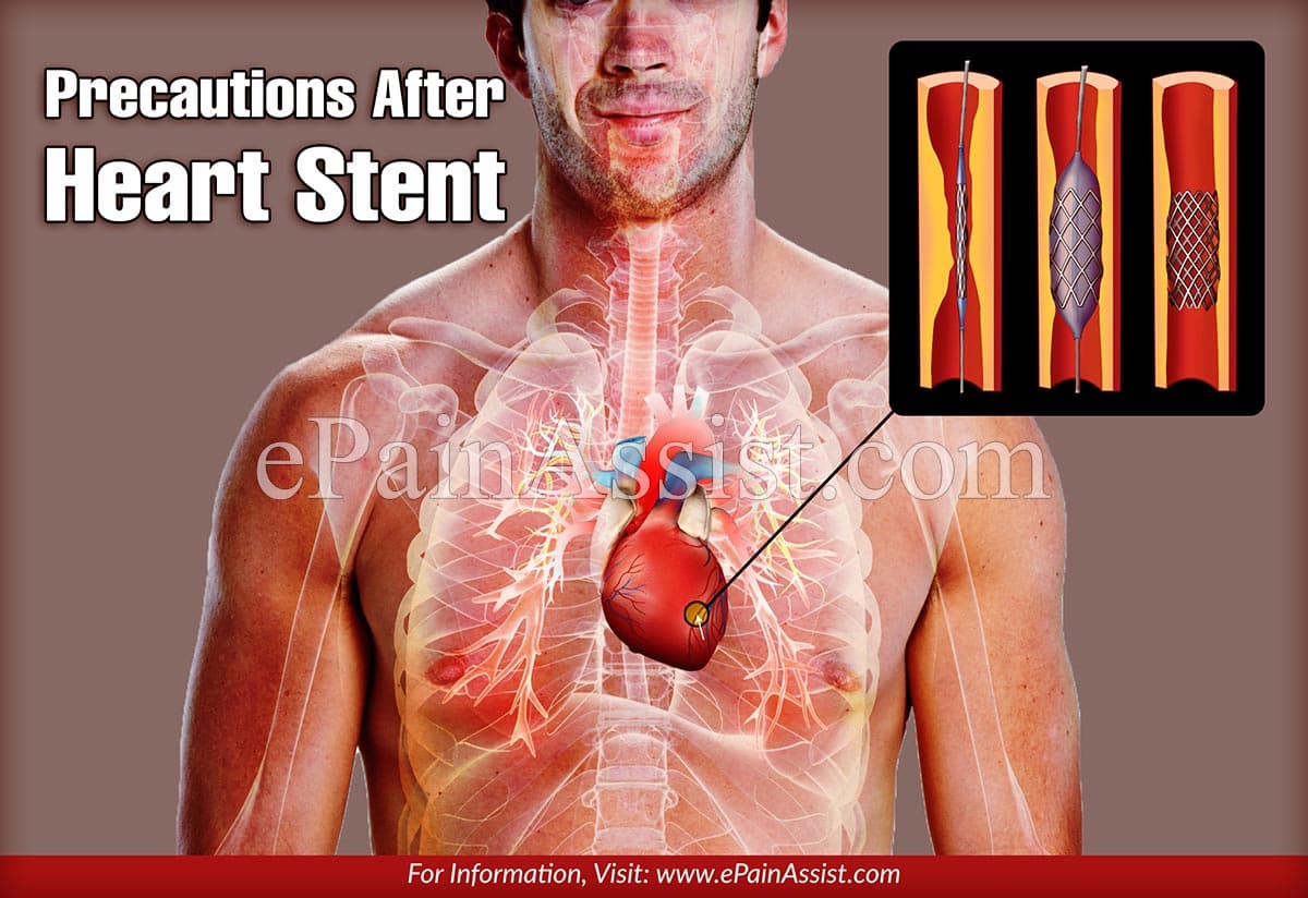 Precautions After Heart Stent