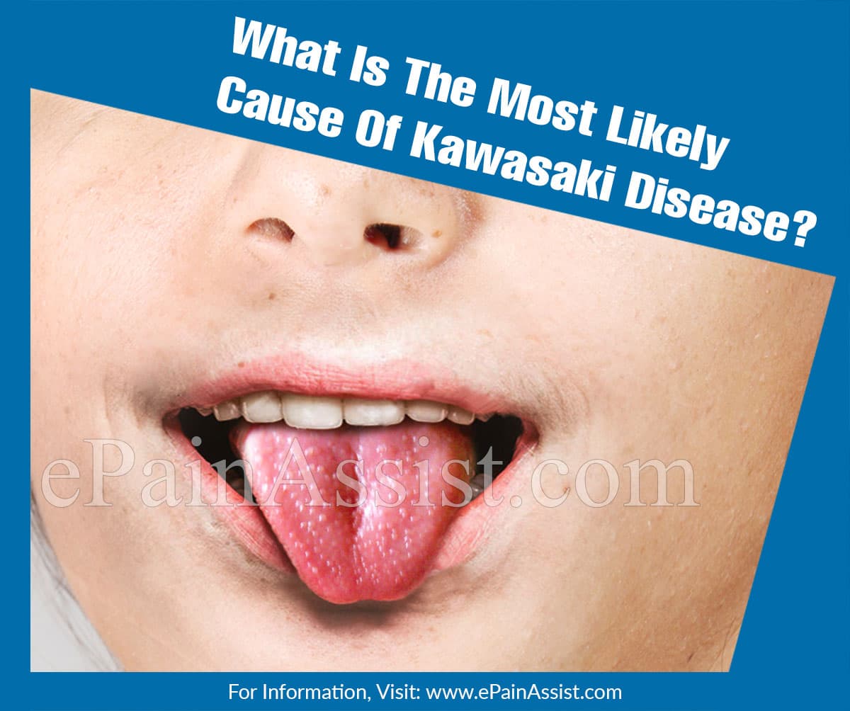 Bedrift auroch musikkens What Is The Most Likely Cause Of Kawasaki Disease?