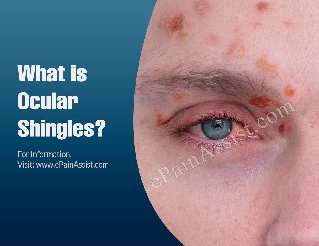 What Is Ocular Shingles Know Its Source Symptoms Diagnosis Treatments