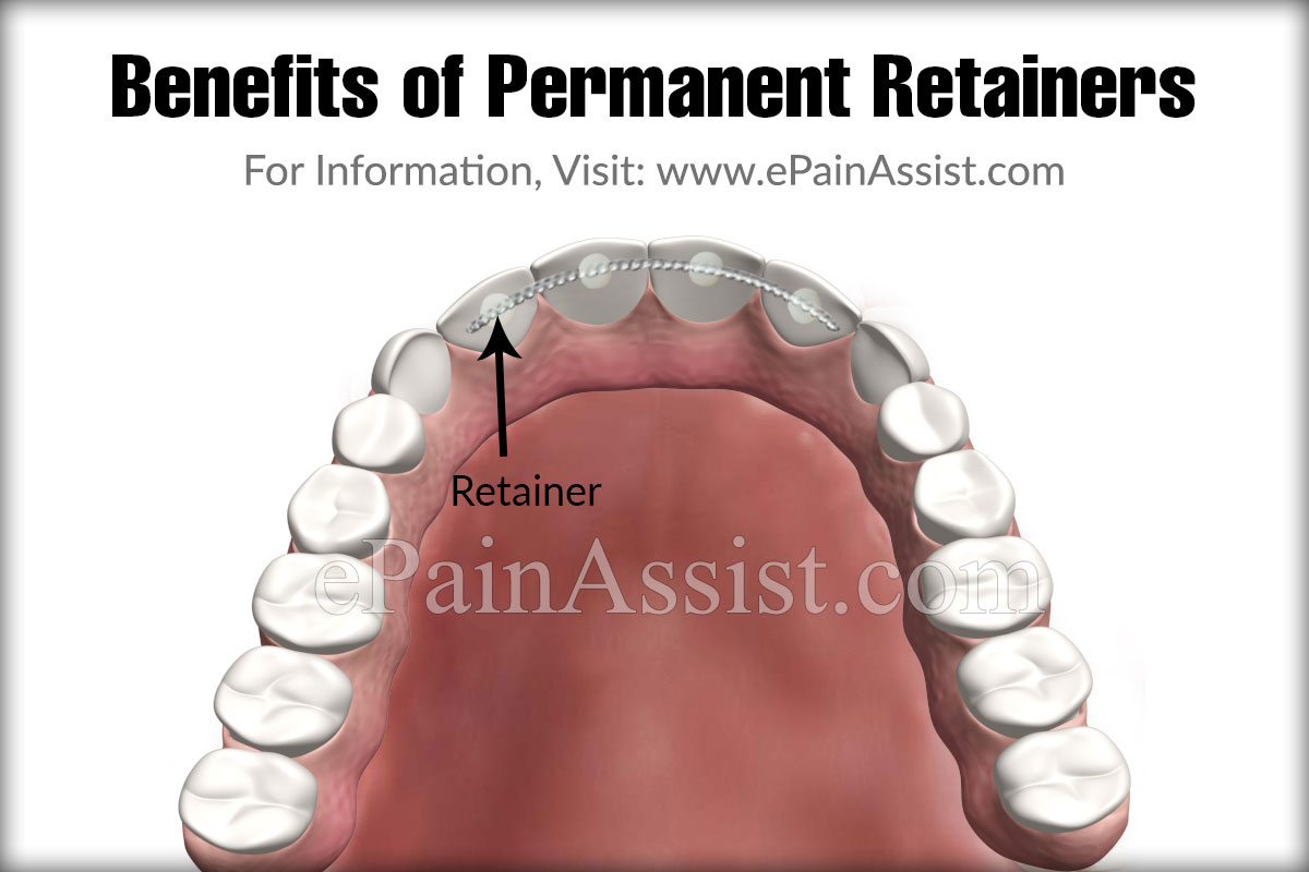 Benefits of Permanent Retainers