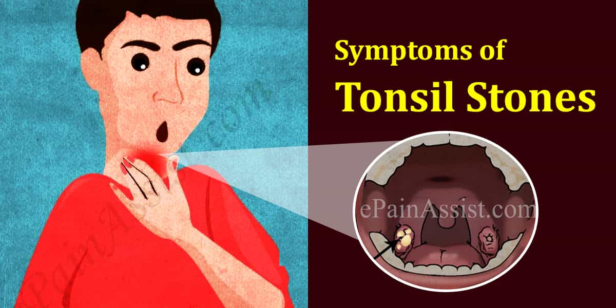 White Spots On Throat (tonsils) - Causes, Symptoms, Treatments FB3