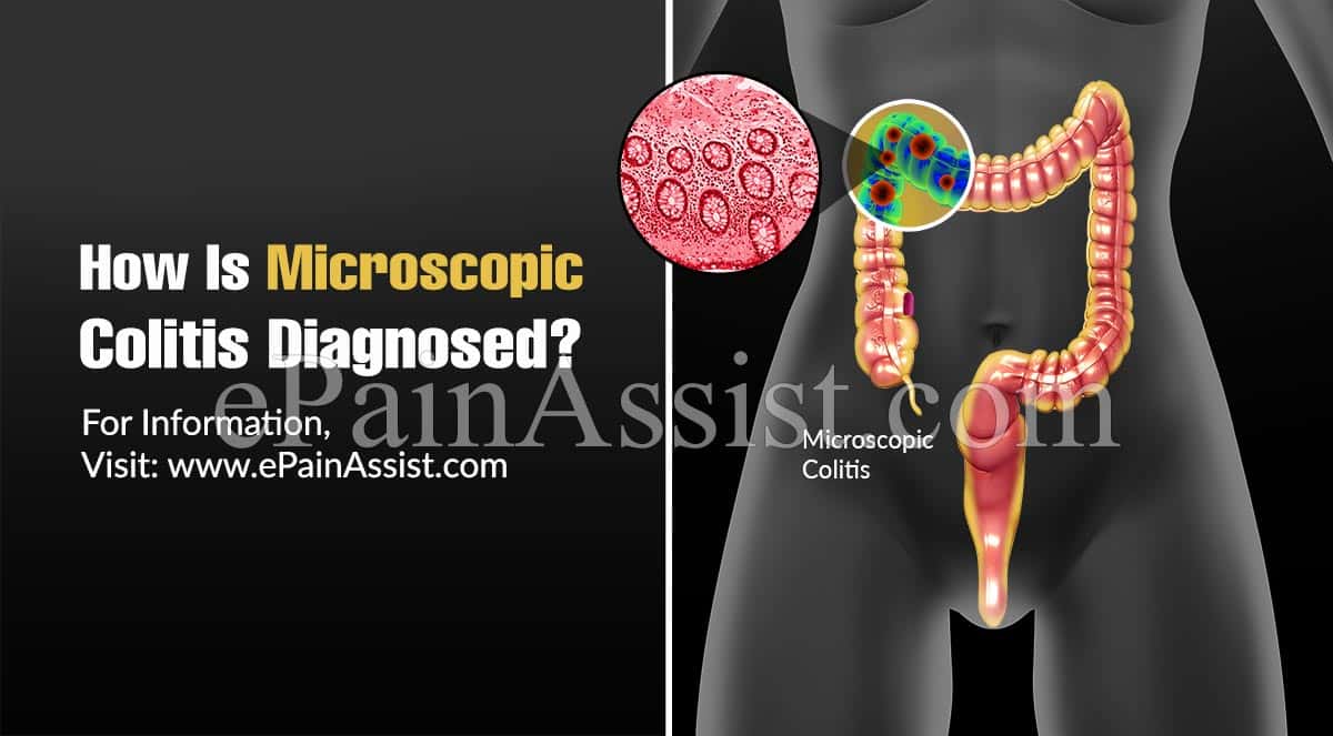 How Is Microscopic Colitis Diagnosed?