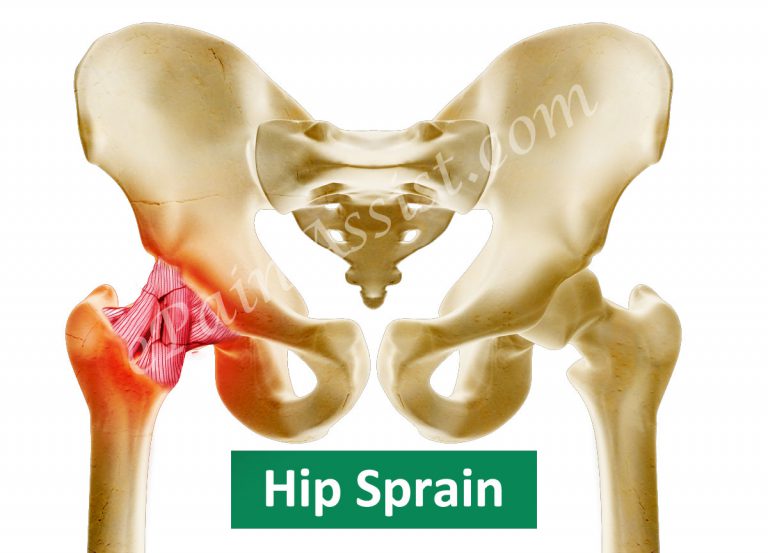 Hip Sprain: Causes, Symptoms, Treatment, Exercises