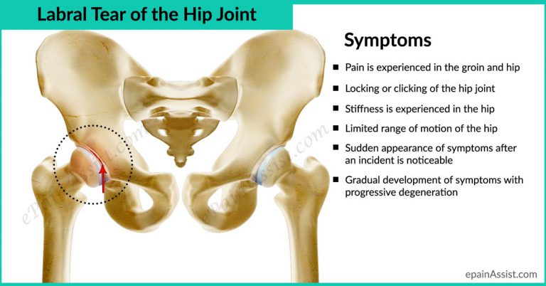 Labral Tear of the Hip Joint