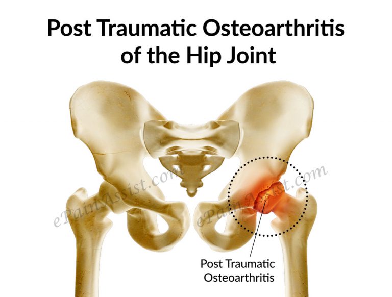 Post Traumatic Osteoarthritis of the Hip Joint: Causes, Signs, Treatment, Exercises