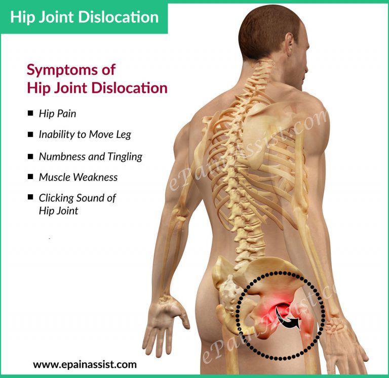What is Hip Dislocation?|Types, Treatment, Exercises for Hip Dislocation