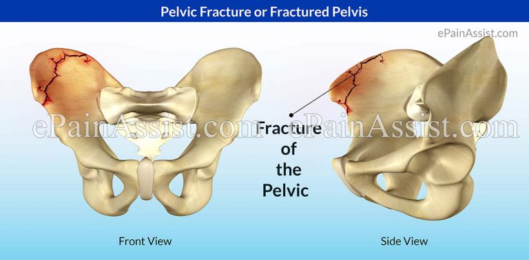 Pelvic Fracture or Fractured Pelvis: Types, Causes, Treatment, 3 Exercises