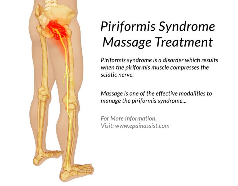 Piriformis Syndrome Massage Treatment