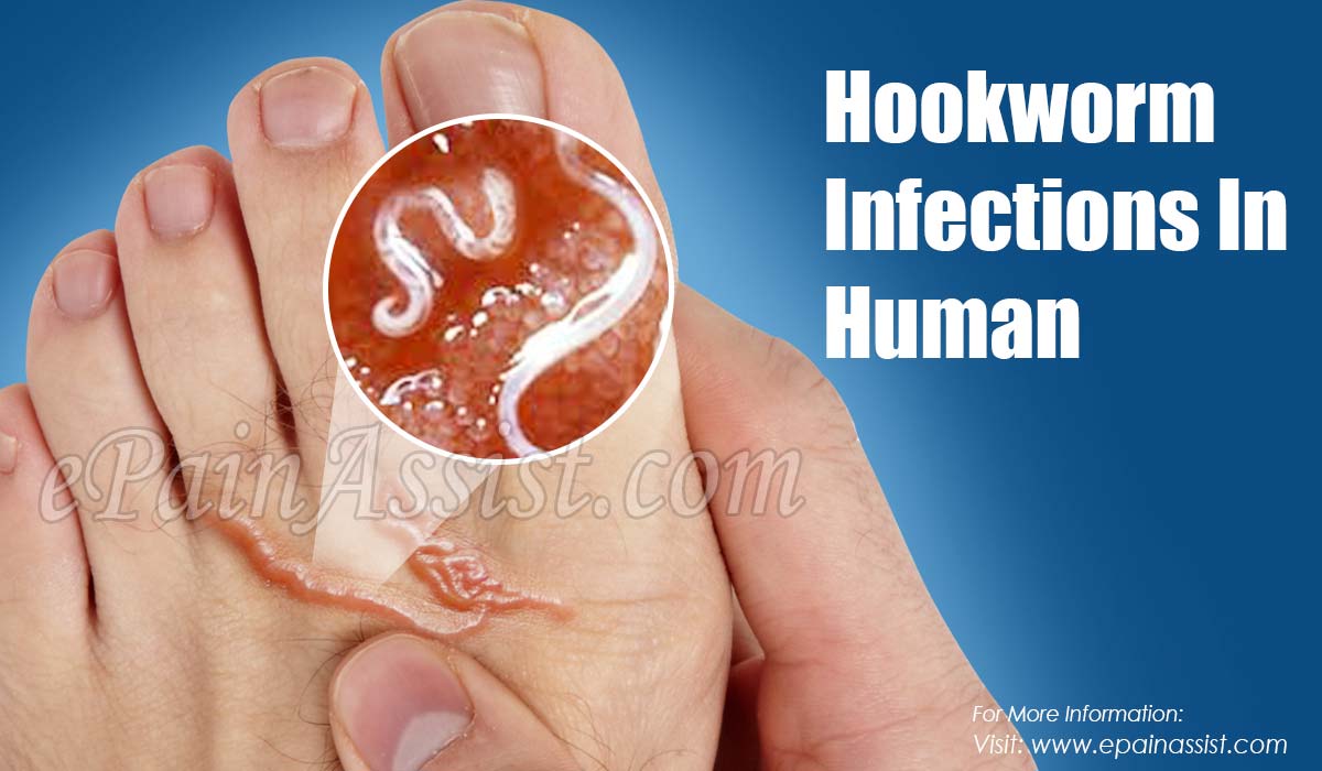 Hookworms in humans diagnosis - bopqefor