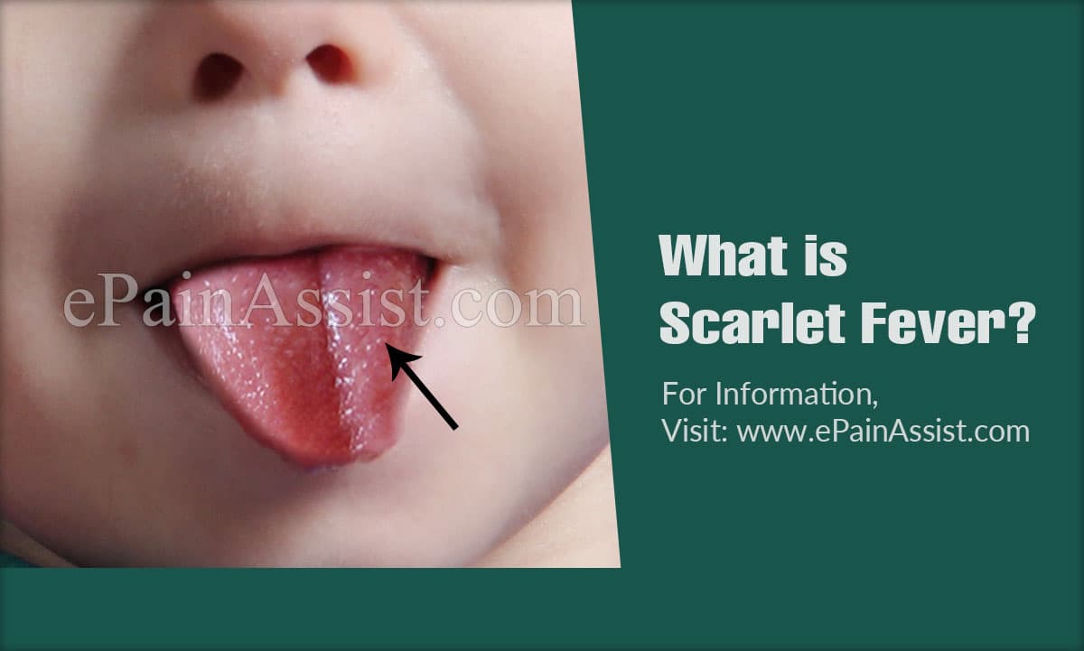 Scarlet Fever Causes Symptoms Treatment
