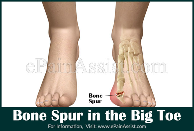 big toe bone spur