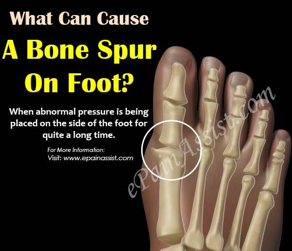 bone spur on the side of my foot