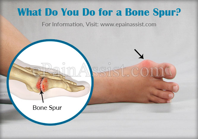 what-do-you-do-for-a-bone-spur