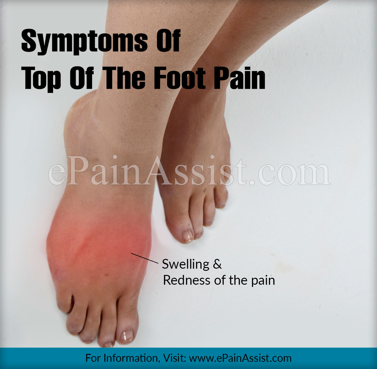 Top of the Foot Pain Treatment, Exercises, Causes, Symptoms