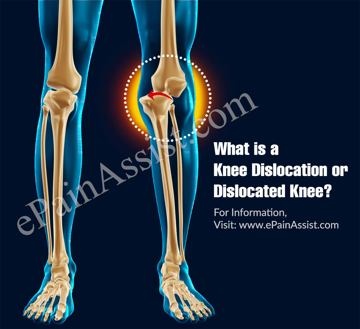 right knee dislocation