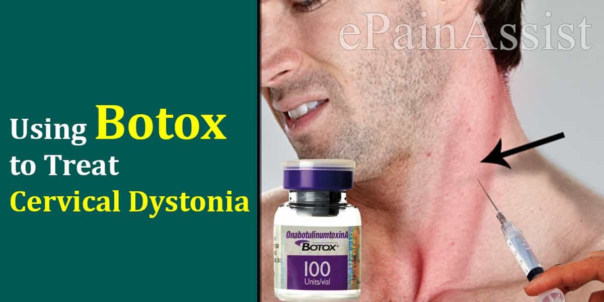 cervical dystonia botox