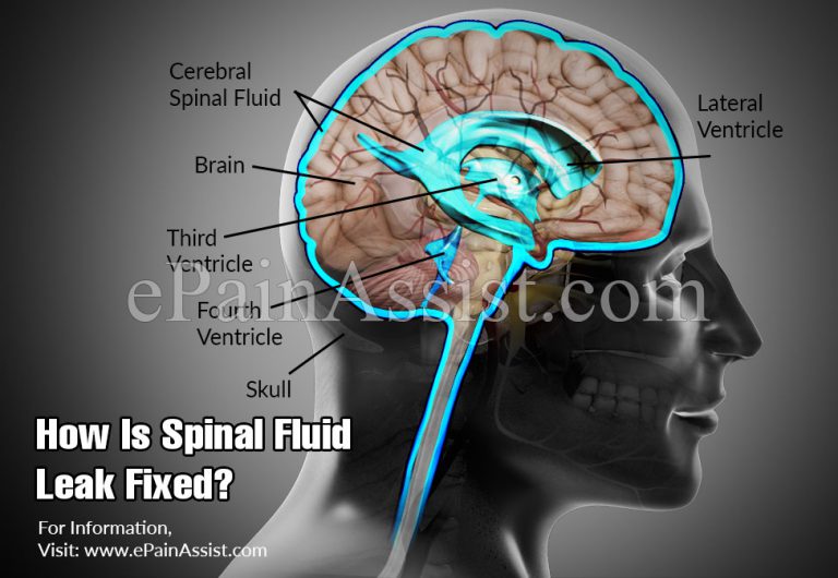 web md cerebrospinal fluid leak