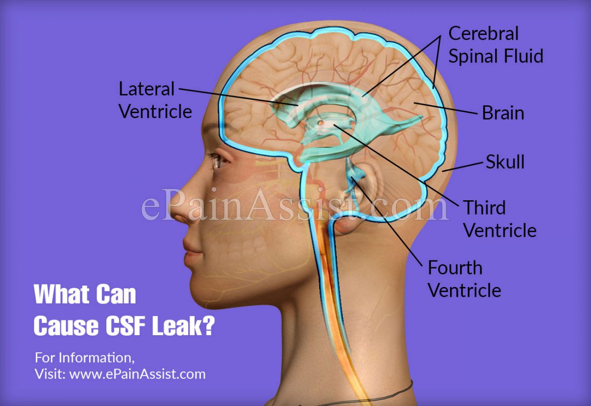leaking cerebrospinal fluid