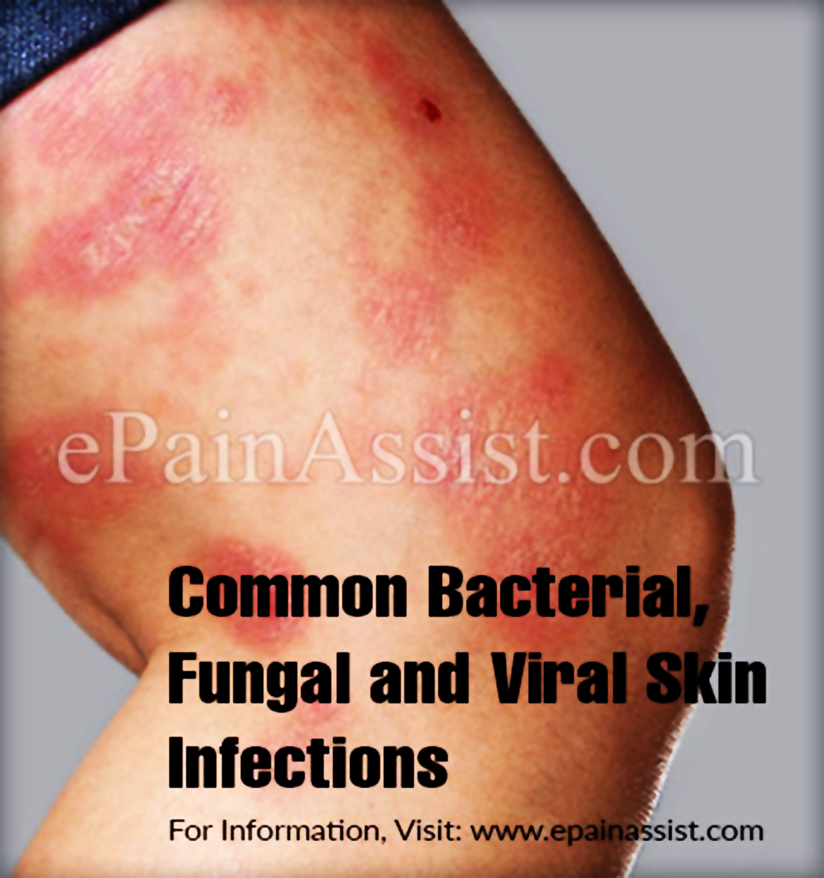Common Bacterial, Fungal and Viral Skin Infections
