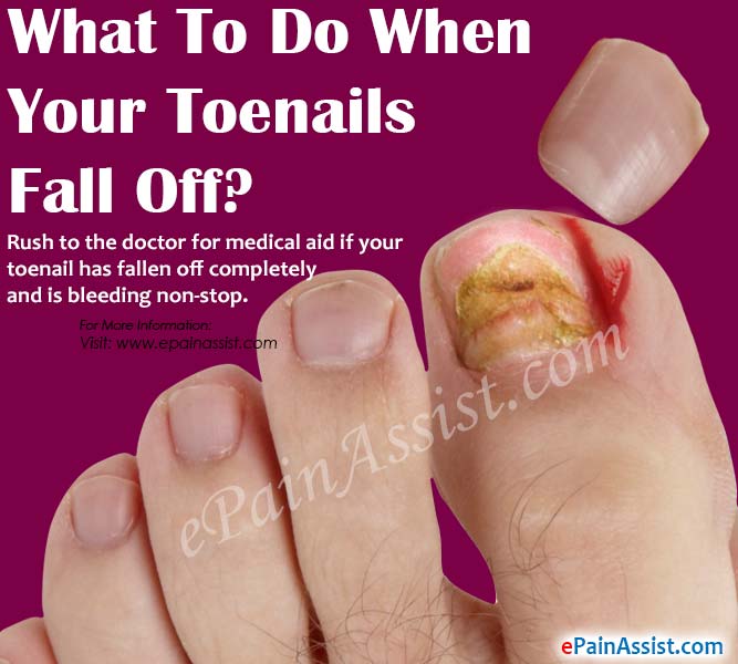 What To Do When Your Toenails Fall Off?