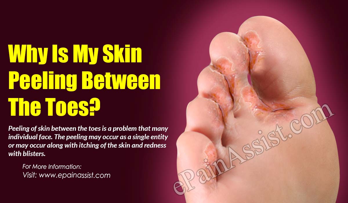 toe peeling and itchy