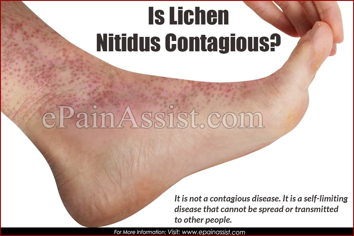 Is Lichen Nitidus Contagious?