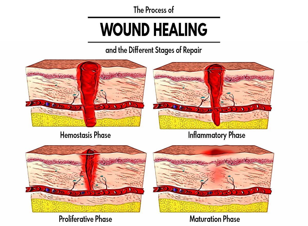 The Process of Wound Healing and the Different Stages of Repair