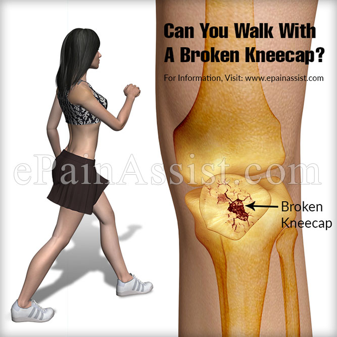 broken kneecap symptoms