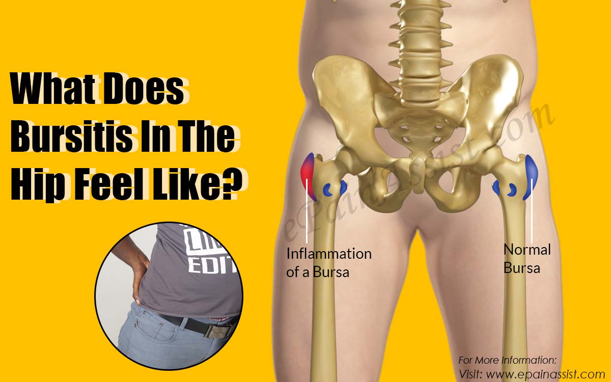 What Does Bursitis In The Hip Feel Like
