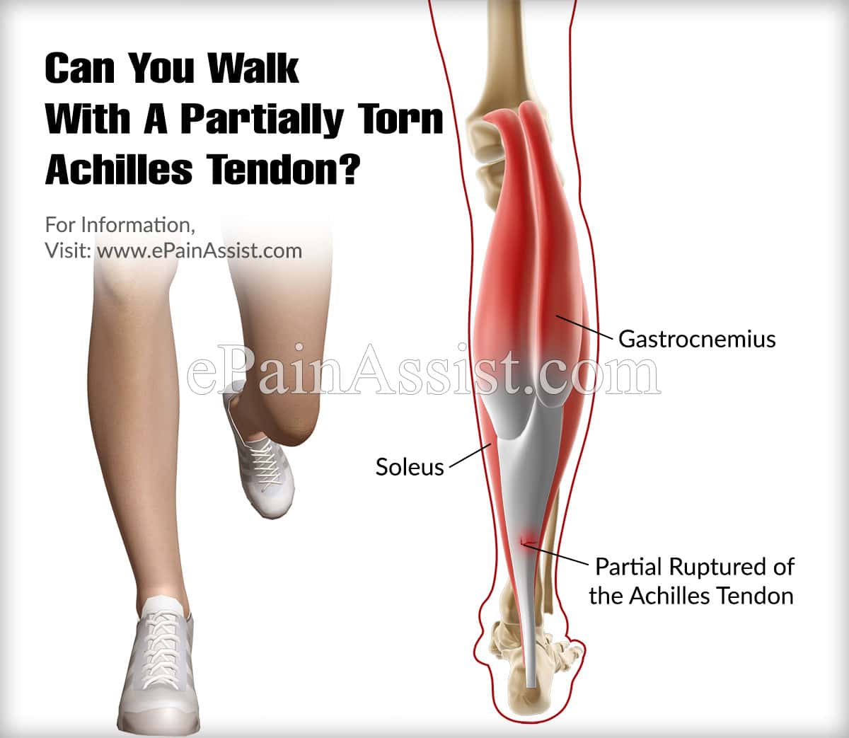 pain in achilles tendon while walking